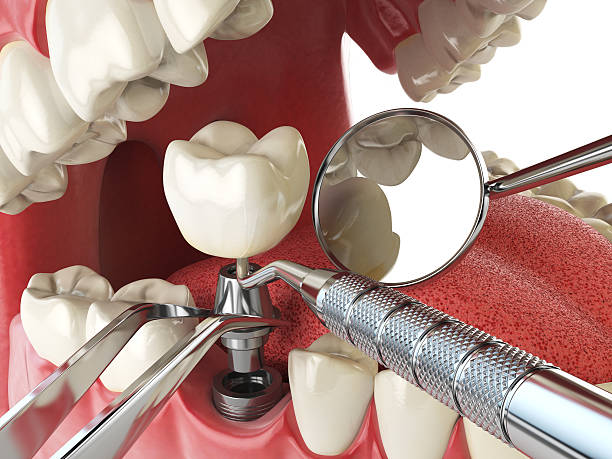 Best Dentist for Tooth Abscess  in St Albans, VT
